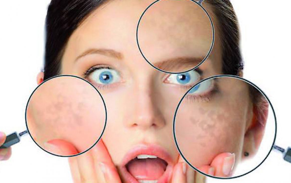 Macchie Scure della Pelle